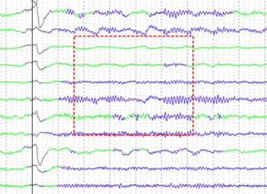 About EEG CDSS